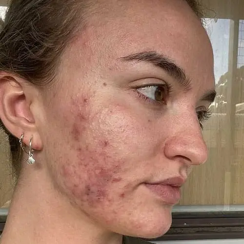 Pele com acne antes do tratamento